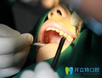 蛀牙導致牙齒缺失 女白領(lǐng)在合肥佳德口腔15分鐘做好種植牙