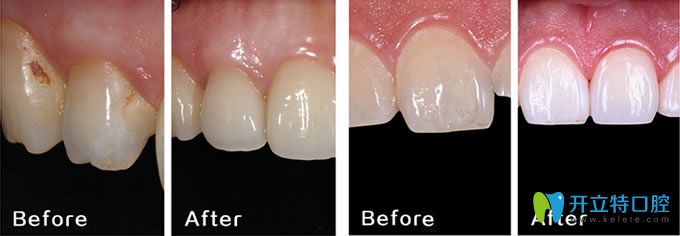 長春晟諾口腔牙齒修復案例