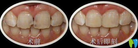 廈門宏沅膛謝良偉前牙美容性修復效果對比圖 廈門宏沅膛謝良偉前牙美容性修復效果對比圖