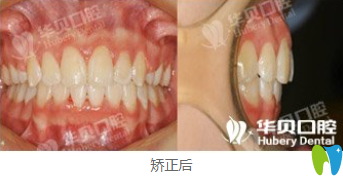 我在濰坊華貝做牙齒矯正后效果圖