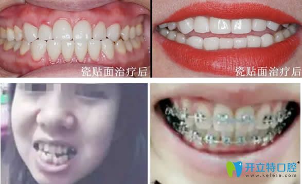 愛德口腔瓷貼面+牙齒矯正效果 愛德口腔瓷貼面+牙齒矯正效果