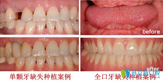 深圳拜博口腔好不好？深圳拜博口腔牙齒種植案例效果來證明實力