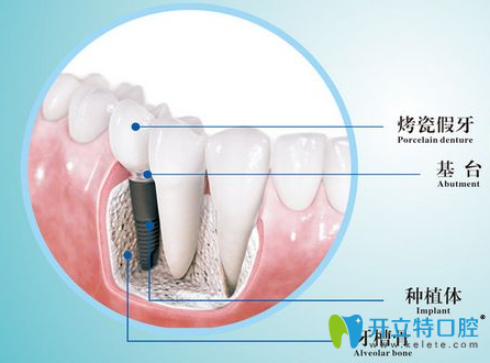 什么是種植牙 長沙雅美口腔醫(yī)生詳解種植牙優(yōu)缺點/注意事項