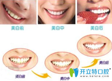 皓齒美白牙齒多少錢？解析步驟及優(yōu)缺點(diǎn)