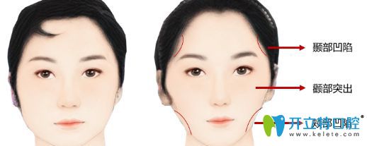 什么是牙套臉?