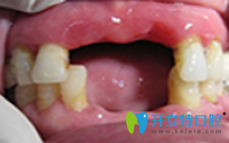 在北京維樂(lè)口腔做微創(chuàng)無(wú)痛種植牙前