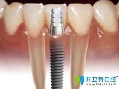 新疆凱樂口腔種植牙
