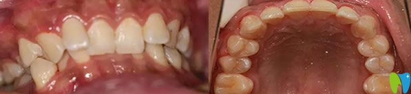 登特口腔牙齒矯正前后效果對(duì)比圖