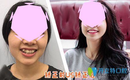 成都歡悅口腔隱形矯正術(shù)前術(shù)后對比案例