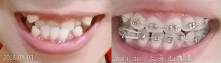 講述我在北京誠之康口腔做牙齒矯正,附3個月矯正過程變化圖