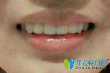 我在濰坊可恩口腔做隱形牙齒矯正一年效果