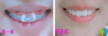 牙齒只有一兩顆不齊可以做半口矯正嗎？來看北京中諾口腔半口牙矯正真人案例