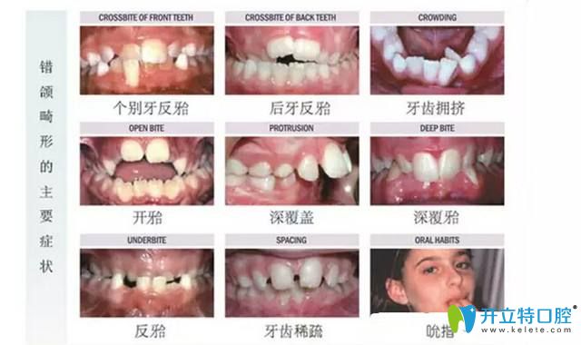 兒童什么樣的牙齒問題需要越早矯正越好