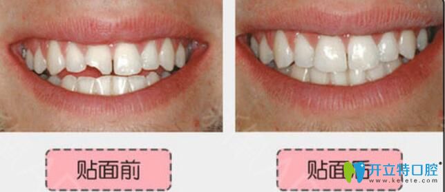 無錫北極星口腔楊亮亮怎么樣？真人案例及反饋來驗證