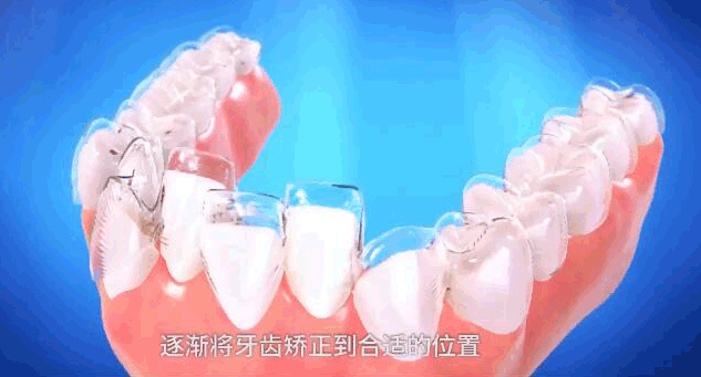 重慶成佳牙博士好不好呢，牙齒矯正效果來(lái)預(yù)見