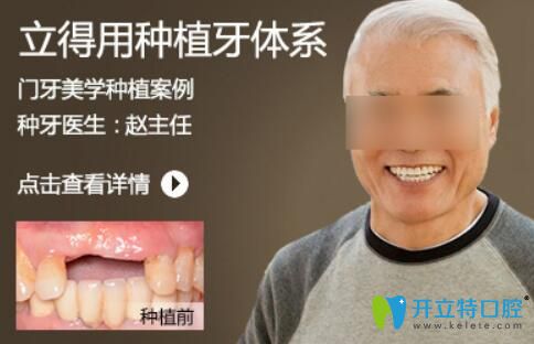 北京中諾趙振宇種植牙怎么樣？案例及顧客反饋來看