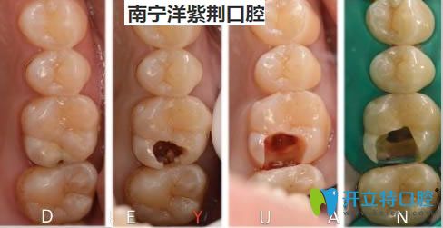 <!--<i data=20240703-sp></i>-->口腔覃琨醫(yī)生根管治療案例對比圖