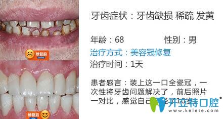 南京博韻口腔周光正靠譜嗎？美容冠修復(fù)案例公布