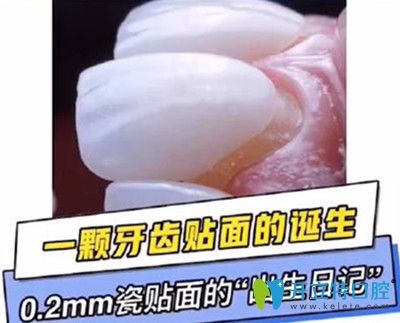 如果瓷貼面做了后悔死了，趕緊來(lái)了解德國(guó)冰瓷牙貼面