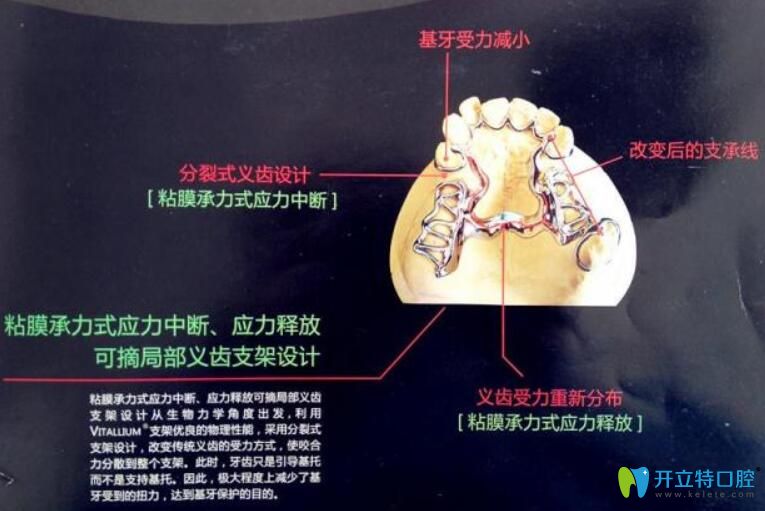 維他靈支架的優(yōu)缺點(diǎn)公布，它和純鈦支架相比好的竟然是…