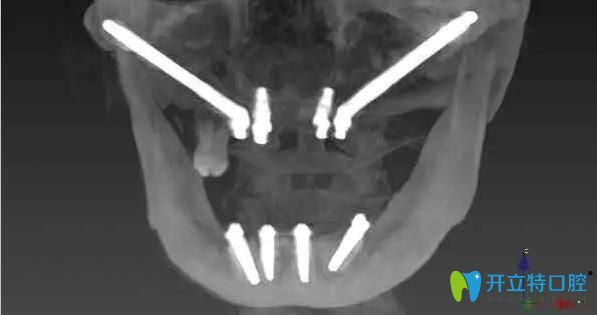南京博韻口腔穿顴骨種植技術