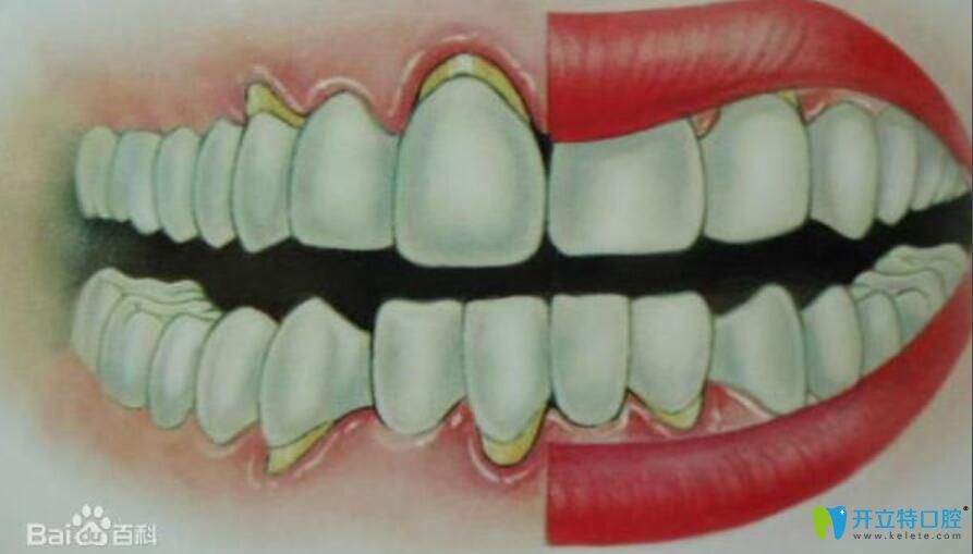 牙槽骨萎縮假牙掛不住，請(qǐng)問牙槽骨萎縮還能恢復(fù)嗎？