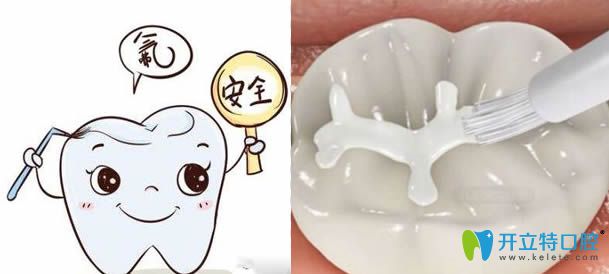 兒童防齲齒-做了窩溝封閉后還需要做涂氟嗎？能同時(shí)做嗎?