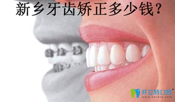 新鄉(xiāng)牙齒矯正價(jià)格表暫以拜博口腔收費(fèi)價(jià)格為示例來參考