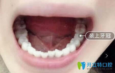 我在深圳諾德口腔做瑞士ITI種植牙后效果 我在深圳諾德口腔做瑞士ITI種植牙后效果