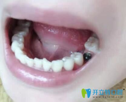 在深圳諾德口腔植入種植體 在深圳諾德口腔植入種植體