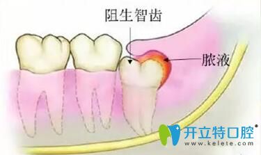 不要再糾結智齒冠周炎能自愈嗎?教你三個方法輕松治療疼痛