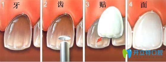 還在糾結(jié)美加牙貼面和義獲嘉瓷貼面選哪個(gè)好嗎?答案來(lái)了!