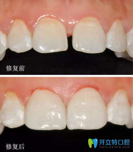 牙齒超薄貼面怎么樣？多少錢(qián)一顆？也許這個(gè)是你更關(guān)心的