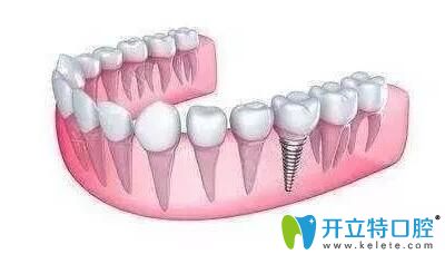 在西安中諾口腔了解到即刻種植牙的優(yōu)勢