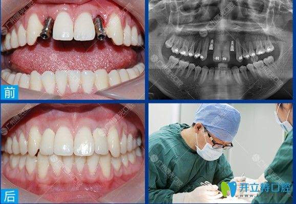 廣州曙光口腔多顆種植牙前后對(duì)比圖 廣州曙光口腔多顆種植牙前后對(duì)比圖