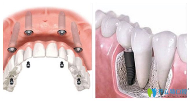 廣州曙光口腔的種植牙技術(shù) 廣州曙光口腔的種植牙技術(shù)