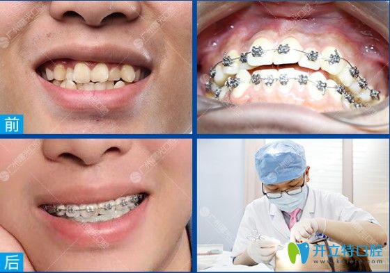 曙光牙科牙齒不齊矯正案例前后對(duì)比圖 曙光牙科牙齒不齊矯正案例前后對(duì)比圖