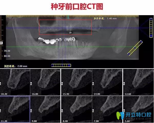 不了解珠海種牙哪家醫(yī)院好，不如看看仁愛口腔即刻種植牙