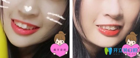 戴ormco陶瓷自鎖托槽矯正一個月后效果