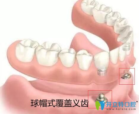 價格吊打種植牙的全口覆蓋義齒修復(fù)到底有哪些優(yōu)缺點？