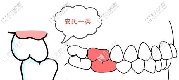 安氏一類(lèi)錯(cuò)頜畸形圖片