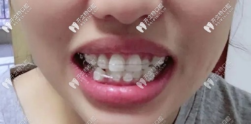 戴陶瓷自鎖托槽中期，牙齒已經(jīng)開始慢慢歸位