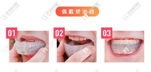 兒童佩戴mrc矯正器