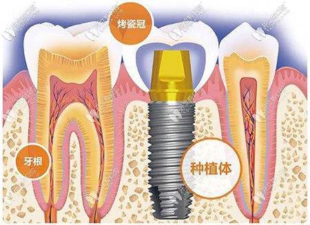 為什么種植牙價(jià)格相差那么大，區(qū)別究竟在哪里？