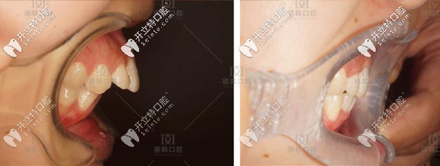 側(cè)面看改善還是很大的