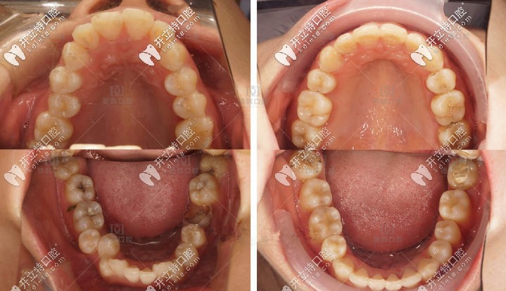 歐巴的口內(nèi)照，牙齒齊了很多撒
