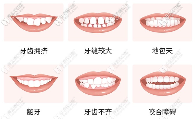 牙齒矯正適應癥