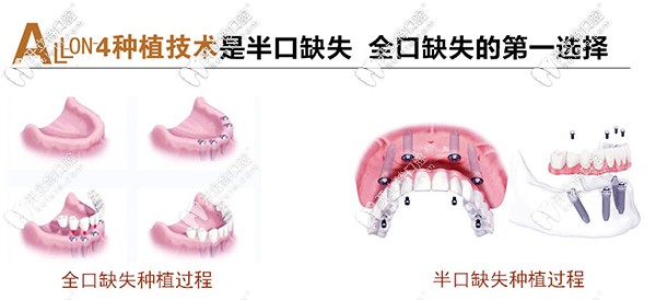 北京市朝陽區(qū)維樂做allon4速導(dǎo)半口種植牙價格是多少？