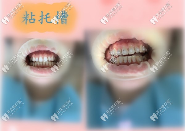 大眾口腔粘托槽