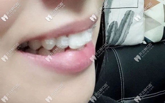 在廣州穗華口腔戴陶瓷半隱形牙套的樣子